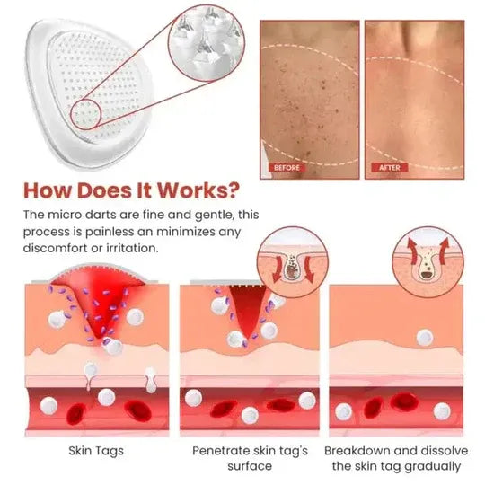 DermaSmooth mole Remover – Safe & Painless Removal